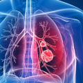 Does anyone survive mesothelioma?
