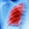 When do mesothelioma symptoms start?