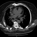 Where does mesothelioma occur?