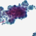 Does mesothelioma spread fast?