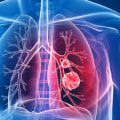 Does everyone who has been exposed to asbestos get mesothelioma?