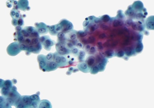 Does mesothelioma spread fast?