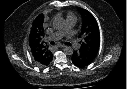 Can mesothelioma be detected early?